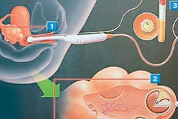 上海红房子三代试管婴儿费用，一次要多少钱？